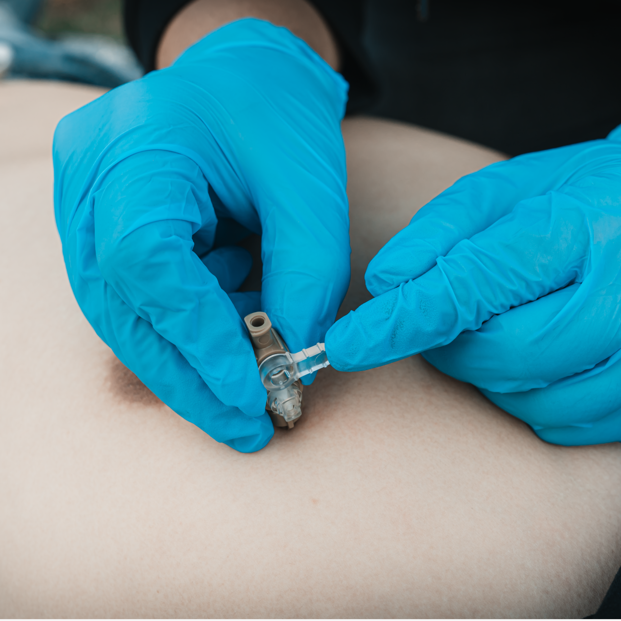 Decompression needle