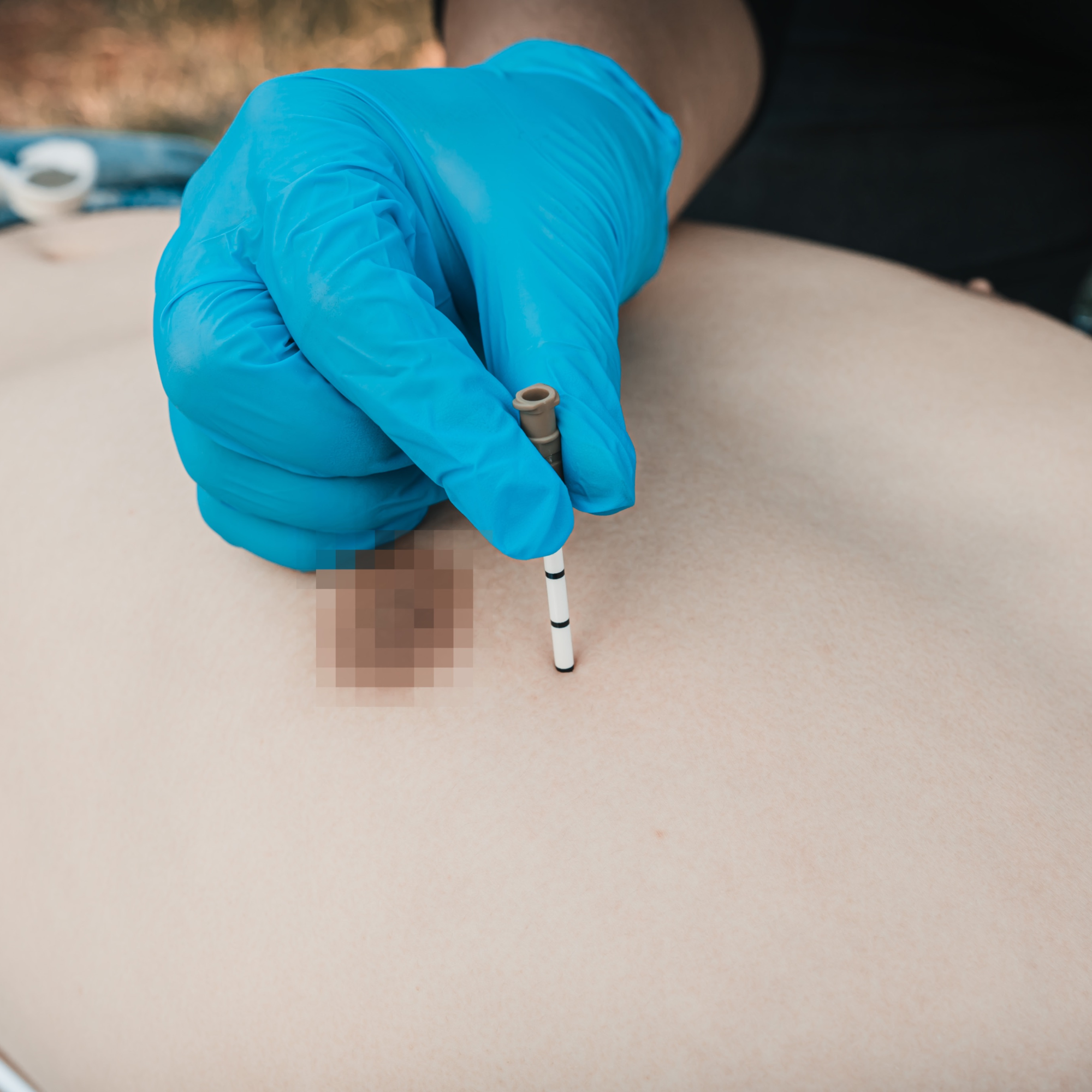 Decompression needle